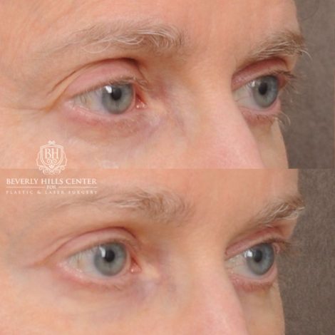 Beverly Hills Center Female Patient Before and After AuraLyft™, Cupid Lift®, Temporal Brow Reset, Upper Blepharoplasty, Fat Grafting, Ptosis Repair