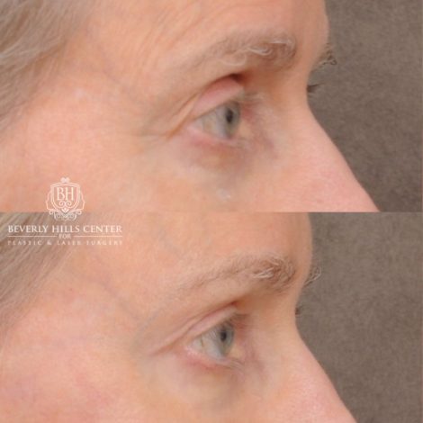 Beverly Hills Center Female Patient Before and After AuraLyft™, Cupid Lift®, Temporal Brow Reset, Upper Blepharoplasty, Fat Grafting, Ptosis Repair