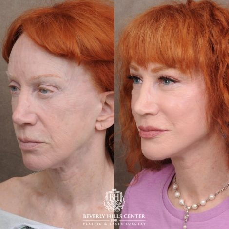 Beverly Hills Center Female Patient Before and After AuraLyft, Cupid Lift®