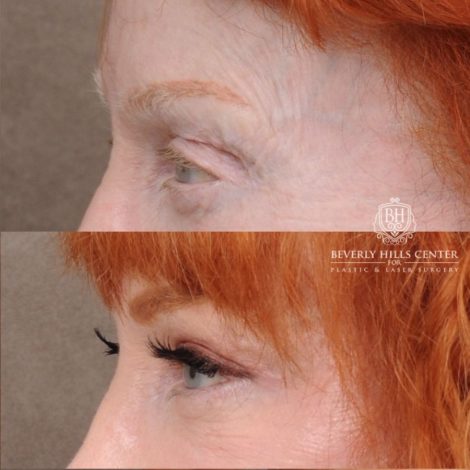 Beverly Hills Center Female Patient Before and After AuraLyft, Cupid Lift®