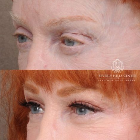 Beverly Hills Center Female Patient Before and After AuraLyft, Cupid Lift®