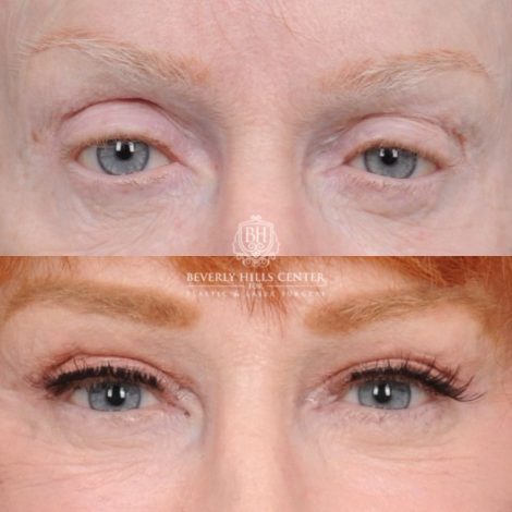 Beverly Hills Center Female Patient Before and After AuraLyft, Cupid Lift®