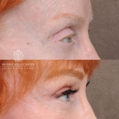 Beverly Hills Center Female Patient Before and After AuraLyft, Cupid Lift®