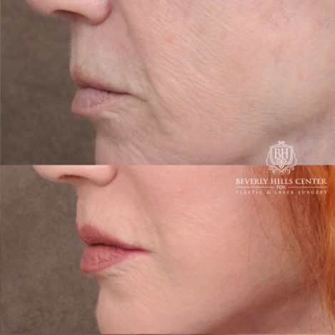 Beverly Hills Center Female Patient Before and After AuraLyft, Cupid Lift®
