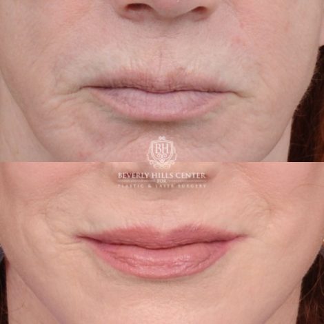 Beverly Hills Center Female Patient Before and After AuraLyft, Cupid Lift®
