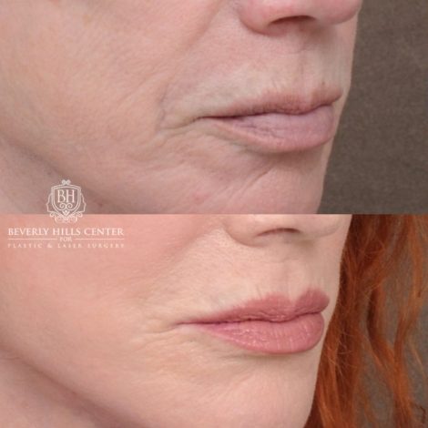Beverly Hills Center Female Patient Before and After AuraLyft, Cupid Lift®