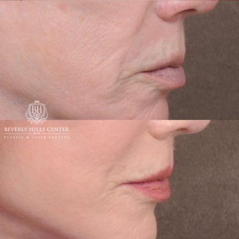 Beverly Hills Center Female Patient Before and After AuraLyft, Cupid Lift®