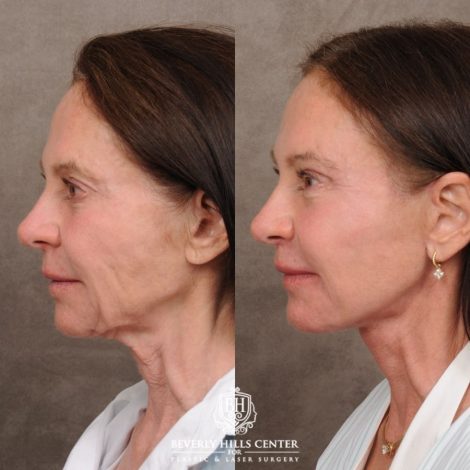 Beverly Hills Center Female Patient Before and After AuraLyft™, Cupid Lift®, Upper Blepharoplasty, Temporal Brow Reset, Ptosis Repair