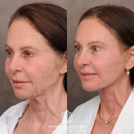 Beverly Hills Center Female Patient Before and After AuraLyft™, Cupid Lift®, Upper Blepharoplasty, Temporal Brow Reset, Ptosis Repair