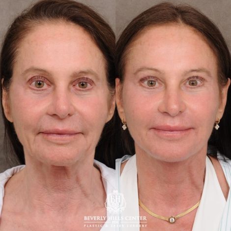 Beverly Hills Center Female Patient Before and After AuraLyft™, Cupid Lift®, Upper Blepharoplasty, Temporal Brow Reset, Ptosis Repair