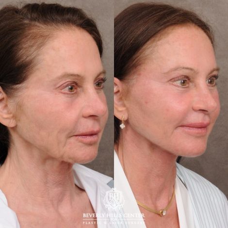 Beverly Hills Center Female Patient Before and After AuraLyft™, Cupid Lift®, Upper Blepharoplasty, Temporal Brow Reset, Ptosis Repair