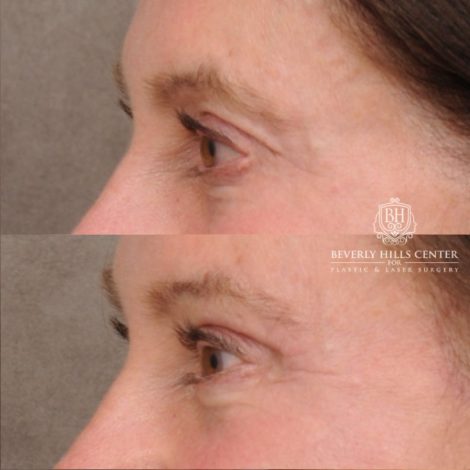Beverly Hills Center Female Patient Before and After AuraLyft™, Cupid Lift®, Upper Blepharoplasty, Temporal Brow Reset, Ptosis Repair