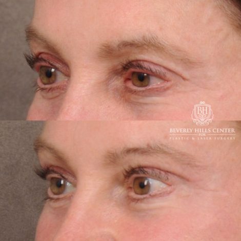 Beverly Hills Center Female Patient Before and After AuraLyft™, Cupid Lift®, Upper Blepharoplasty, Temporal Brow Reset, Ptosis Repair