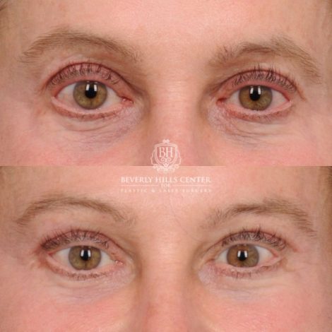 Beverly Hills Center Female Patient Before and After AuraLyft™, Cupid Lift®, Upper Blepharoplasty, Temporal Brow Reset, Ptosis Repair