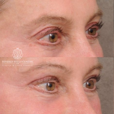 Beverly Hills Center Female Patient Before and After AuraLyft™, Cupid Lift®, Upper Blepharoplasty, Temporal Brow Reset, Ptosis Repair