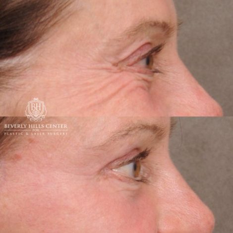 Beverly Hills Center Female Patient Before and After AuraLyft™, Cupid Lift®, Upper Blepharoplasty, Temporal Brow Reset, Ptosis Repair