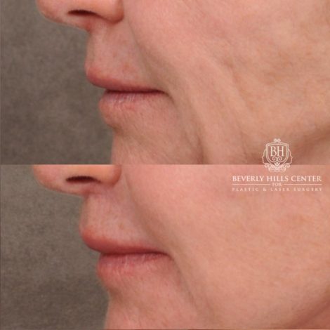 Beverly Hills Center Female Patient Before and After AuraLyft™, Cupid Lift®, Upper Blepharoplasty, Temporal Brow Reset, Ptosis Repair