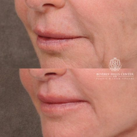Beverly Hills Center Female Patient Before and After AuraLyft™, Cupid Lift®, Upper Blepharoplasty, Temporal Brow Reset, Ptosis Repair