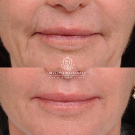 Beverly Hills Center Female Patient Before and After AuraLyft™, Cupid Lift®, Upper Blepharoplasty, Temporal Brow Reset, Ptosis Repair
