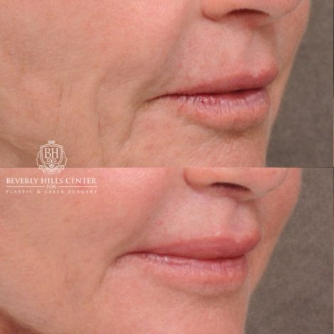 Beverly Hills Center Female Patient Before and After AuraLyft™, Cupid Lift®, Upper Blepharoplasty, Temporal Brow Reset, Ptosis Repair