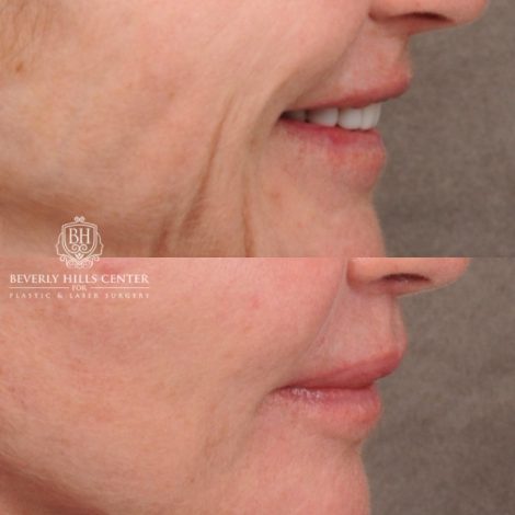 Beverly Hills Center Female Patient Before and After AuraLyft™, Cupid Lift®, Upper Blepharoplasty, Temporal Brow Reset, Ptosis Repair