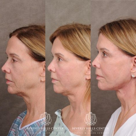 Beverly Hills Center Female Patient Before and After Upper Blepharoplasty, Profound RF, Osteoma Excision, Nano Fat with PRP