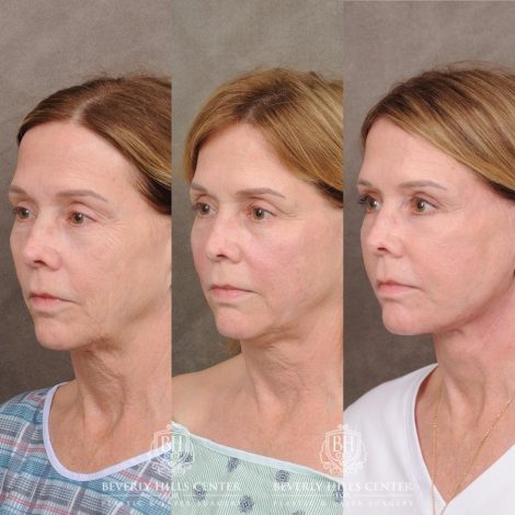 Beverly Hills Center Female Patient Before and After Upper Blepharoplasty, Profound RF, Osteoma Excision, Nano Fat with PRP