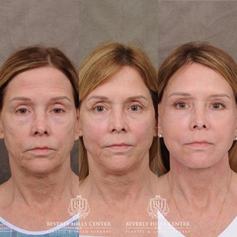 Beverly Hills Center Female Patient Before and After Upper Blepharoplasty, Profound RF, Osteoma Excision, Nano Fat with PRP
