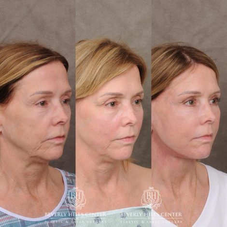 Beverly Hills Center Female Patient Before and After Upper Blepharoplasty, Profound RF, Osteoma Excision, Nano Fat with PRP