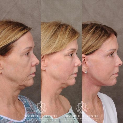Beverly Hills Center Female Patient Before and After Upper Blepharoplasty, Profound RF, Osteoma Excision, Nano Fat with PRP