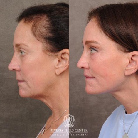 Beverly Hills Center Female Patient Before and After AuraLyft™, Cupid Lift®, Temporal Brow Reset, Nanofat