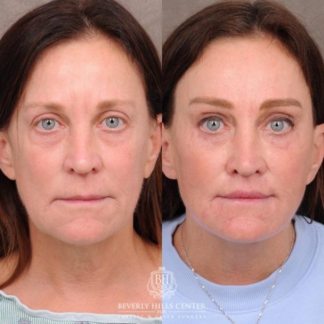 Beverly Hills Center Female Patient Before and After AuraLyft™, Cupid Lift®, Temporal Brow Reset, Nanofat