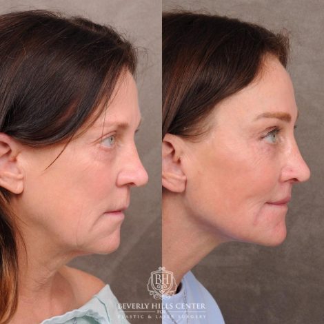 Beverly Hills Center Female Patient Before and After AuraLyft™, Cupid Lift®, Temporal Brow Reset, Nanofat