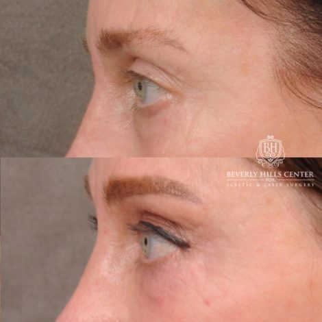 Beverly Hills Center Female Patient Before and After AuraLyft™, Cupid Lift®, Temporal Brow Reset, Nanofat