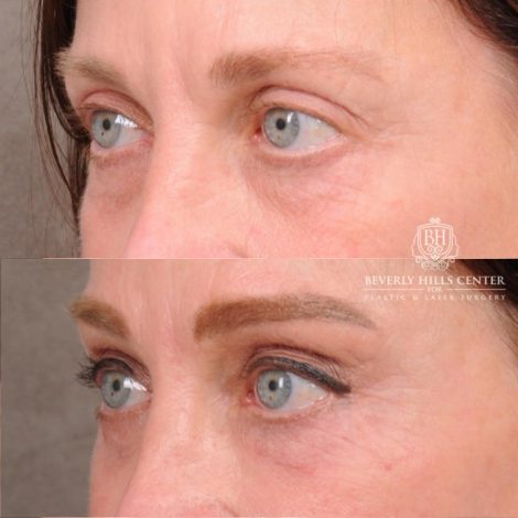 Beverly Hills Center Female Patient Before and After AuraLyft™, Cupid Lift®, Temporal Brow Reset, Nanofat