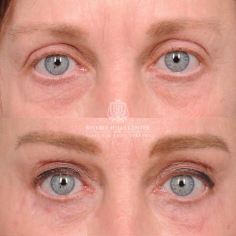 Beverly Hills Center Female Patient Before and After AuraLyft™, Cupid Lift®, Temporal Brow Reset, Nanofat