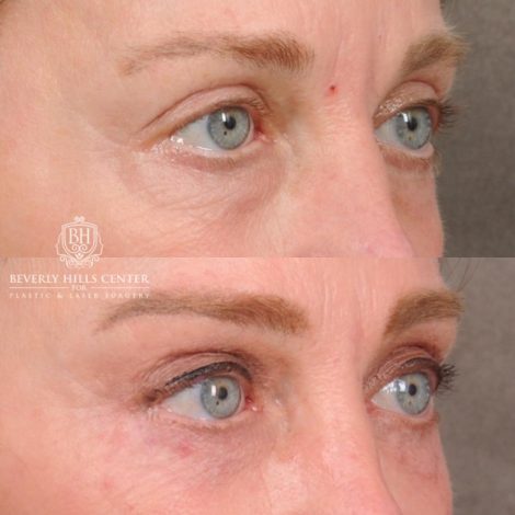 Beverly Hills Center Female Patient Before and After AuraLyft™, Cupid Lift®, Temporal Brow Reset, Nanofat