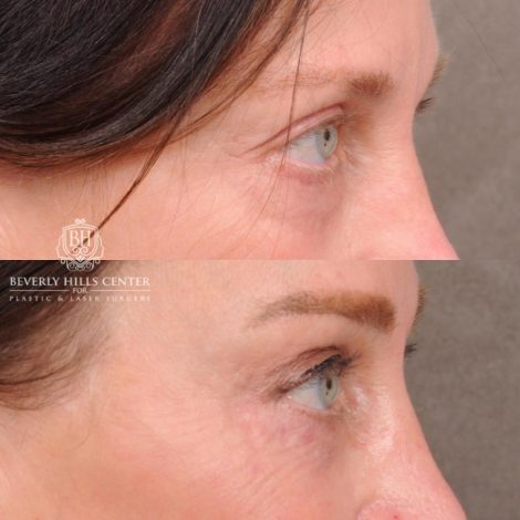 Beverly Hills Center Female Patient Before and After AuraLyft™, Cupid Lift®, Temporal Brow Reset, Nanofat