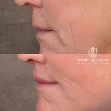 Beverly Hills Center Female Patient Before and After AuraLyft™, Cupid Lift®, Temporal Brow Reset, Nanofat