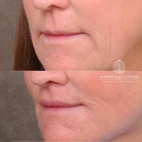 Beverly Hills Center Female Patient Before and After AuraLyft™, Cupid Lift®, Temporal Brow Reset, Nanofat