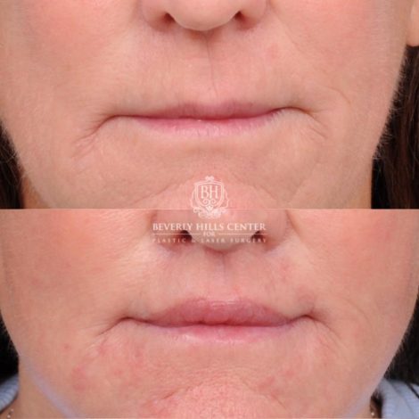 Beverly Hills Center Female Patient Before and After AuraLyft™, Cupid Lift®, Temporal Brow Reset, Nanofat