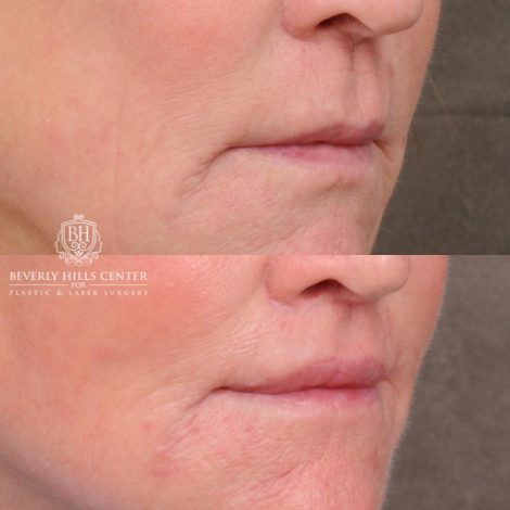 Beverly Hills Center Female Patient Before and After AuraLyft™, Cupid Lift®, Temporal Brow Reset, Nanofat