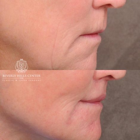 Beverly Hills Center Female Patient Before and After AuraLyft™, Cupid Lift®, Temporal Brow Reset, Nanofat