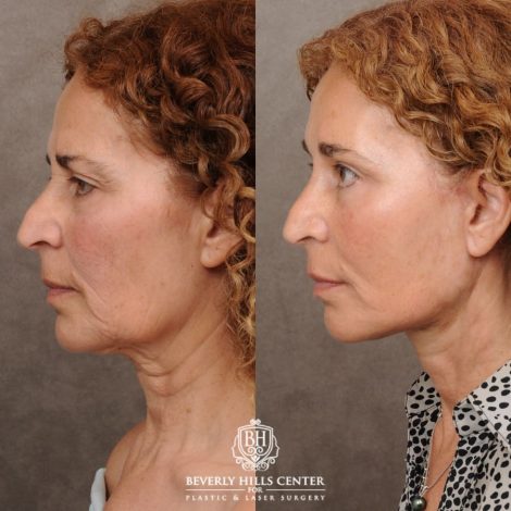Beverly Hills Center Female Patient Before and After AuraLyft, Temporal Brow Reset, Upper Blepharoplasty, Fat Grafting, Ptosis Repair
