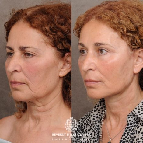 Beverly Hills Center Female Patient Before and After AuraLyft, Temporal Brow Reset, Upper Blepharoplasty, Fat Grafting, Ptosis Repair