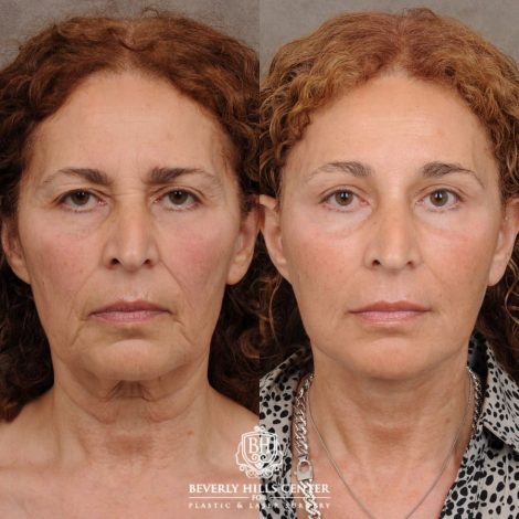 Beverly Hills Center Female Patient Before and After AuraLyft, Temporal Brow Reset, Upper Blepharoplasty, Fat Grafting, Ptosis Repair