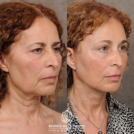 Beverly Hills Center Female Patient Before and After AuraLyft, Temporal Brow Reset, Upper Blepharoplasty, Fat Grafting, Ptosis Repair