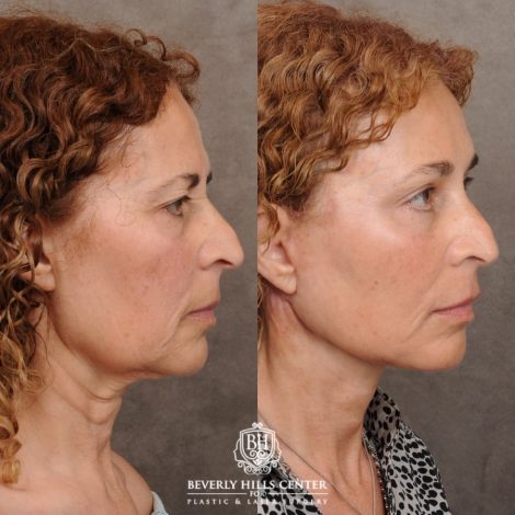 Beverly Hills Center Female Patient Before and After AuraLyft, Temporal Brow Reset, Upper Blepharoplasty, Fat Grafting, Ptosis Repair