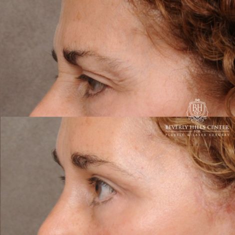 Beverly Hills Center Female Patient Before and After AuraLyft, Temporal Brow Reset, Upper Blepharoplasty, Fat Grafting, Ptosis Repair