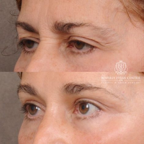 Beverly Hills Center Female Patient Before and After AuraLyft, Temporal Brow Reset, Upper Blepharoplasty, Fat Grafting, Ptosis Repair